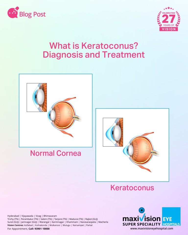 What is Keratoconus? Diagnosis and Treatment