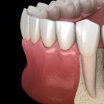 The Ultimate Guide to Dental Implants in NJ: Costs, Procedure, and Benefits